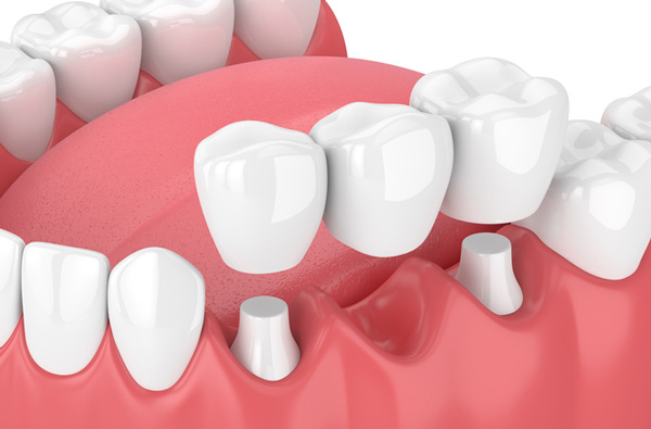An example of a complete fixed dental bridge at Lincoln Center Smiles in Portland, OR An example of a complete fixed dental bridge at Lincoln Center Smiles in Portland, OR